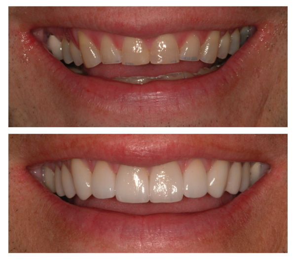 invisalign before and after gap