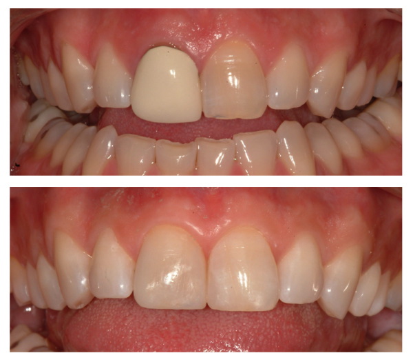 teeth braces before and after. teeth braces cost.